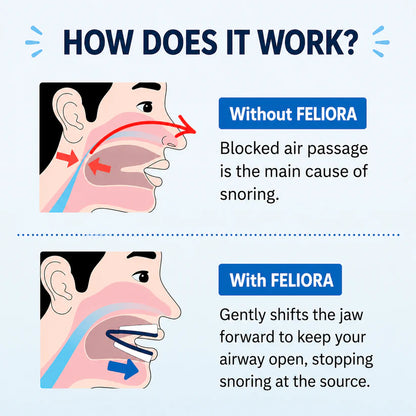 Feliora Anti-Snoring Mouthpiece